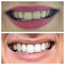 Load image into Gallery viewer, Miami Teeth Whitening
